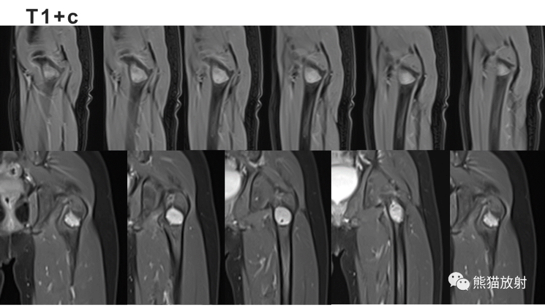 【病例】长骨非骨化性纤维瘤2例X线CT及MR-8