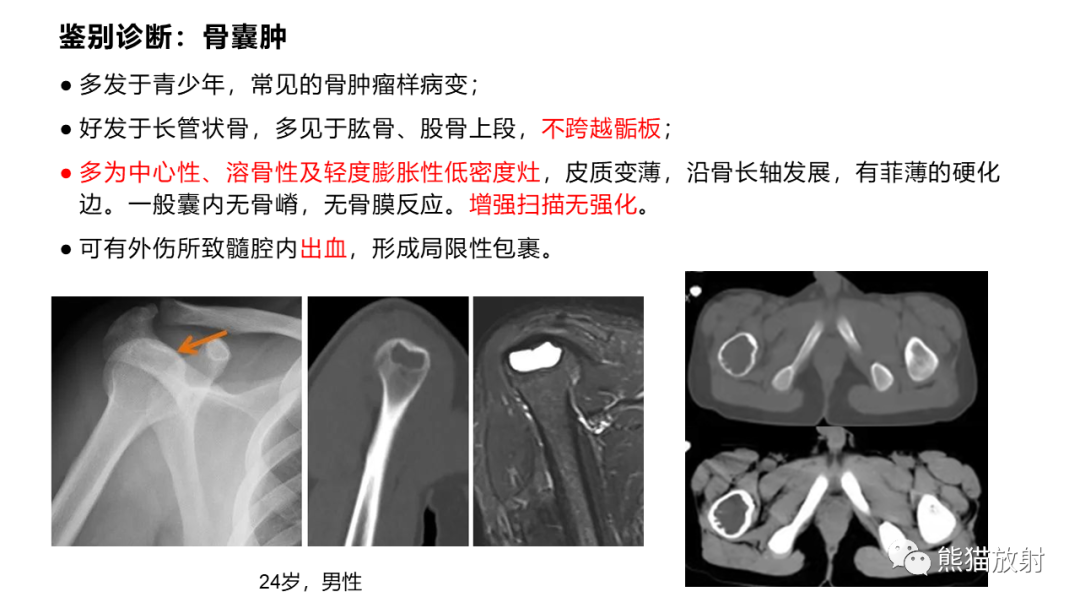 【病例】长骨非骨化性纤维瘤2例X线CT及MR-32