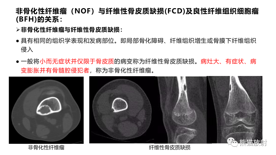 【病例】长骨非骨化性纤维瘤2例X线CT及MR-30