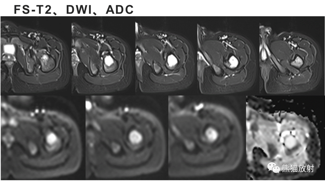 【病例】长骨非骨化性纤维瘤2例X线CT及MR-6