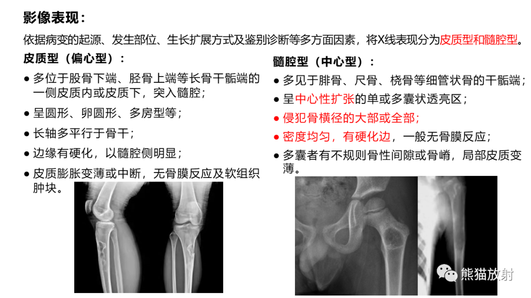 【病例】长骨非骨化性纤维瘤2例X线CT及MR-26