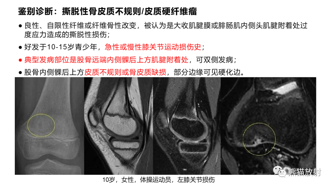 【病例】长骨非骨化性纤维瘤2例X线CT及MR-36