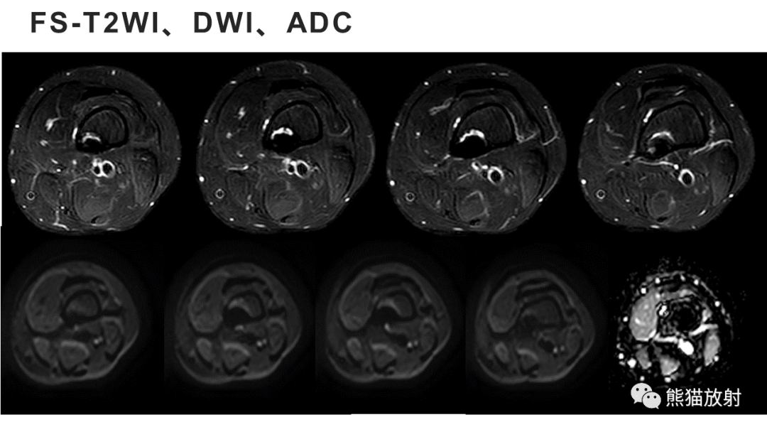 【病例】长骨非骨化性纤维瘤2例X线CT及MR-20