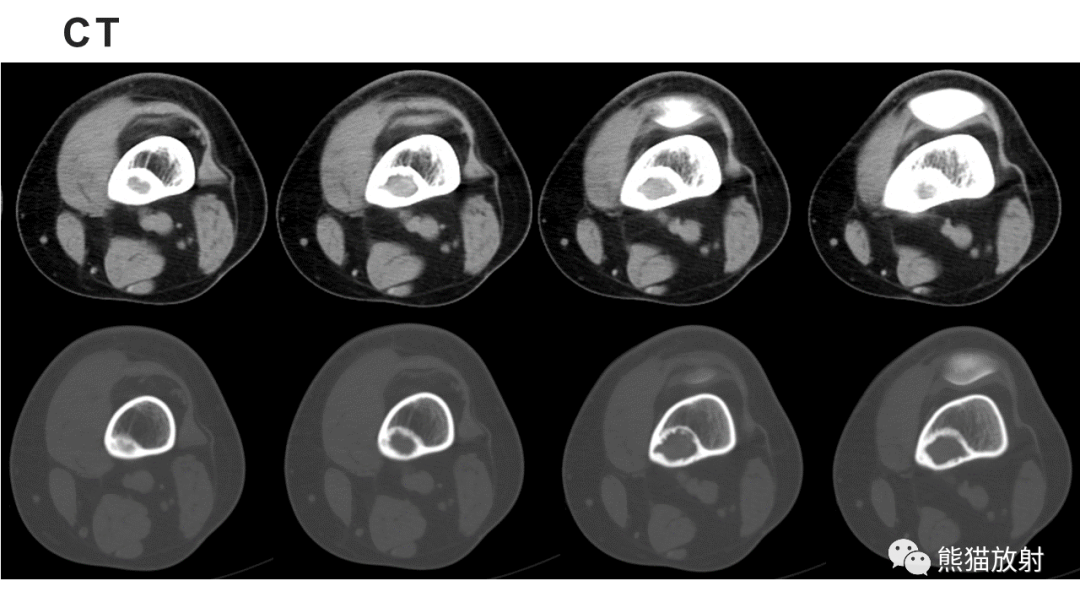 【病例】长骨非骨化性纤维瘤2例X线CT及MR-16