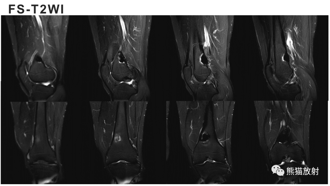 【病例】长骨非骨化性纤维瘤2例X线CT及MR-19