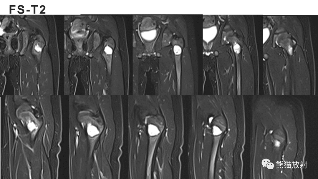 【病例】长骨非骨化性纤维瘤2例X线CT及MR-5