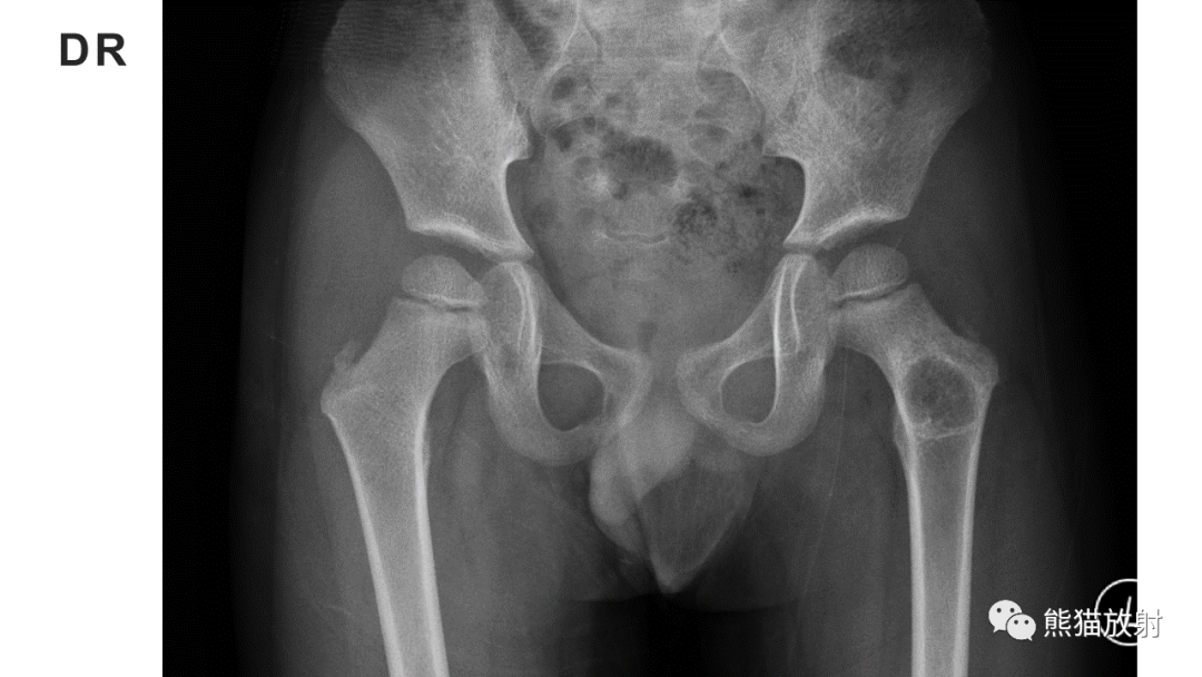 【病例】长骨非骨化性纤维瘤2例X线CT及MR-9