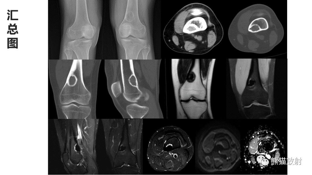 【病例】长骨非骨化性纤维瘤2例X线CT及MR-21