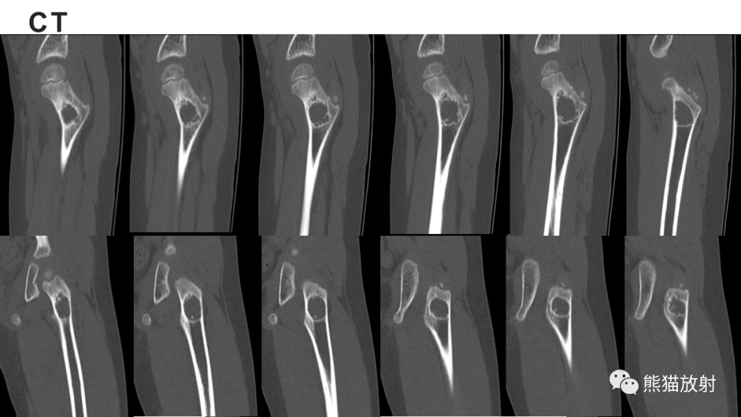 【病例】长骨非骨化性纤维瘤2例X线CT及MR-11