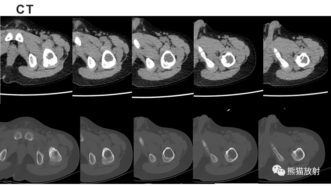 【病例】长骨非骨化性纤维瘤2例X线CT及MR-10