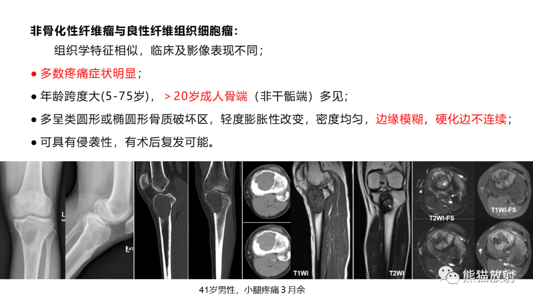 【病例】长骨非骨化性纤维瘤2例X线CT及MR-31