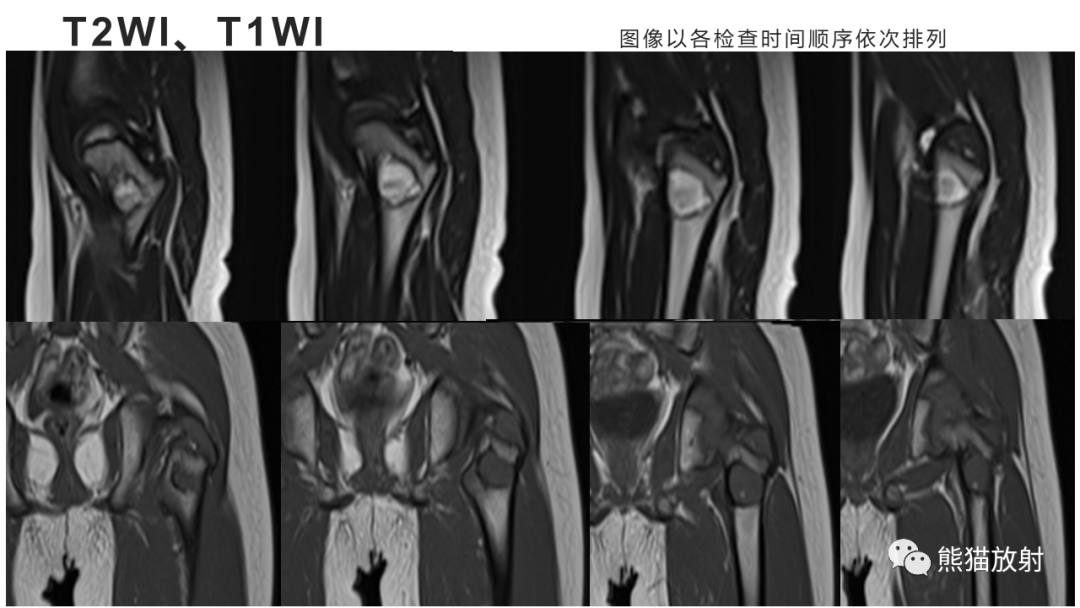 【病例】长骨非骨化性纤维瘤2例X线CT及MR-4