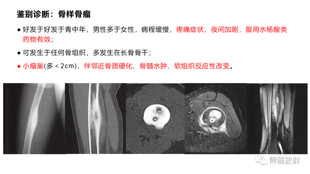 【病例】长骨非骨化性纤维瘤2例X线CT及MR-35