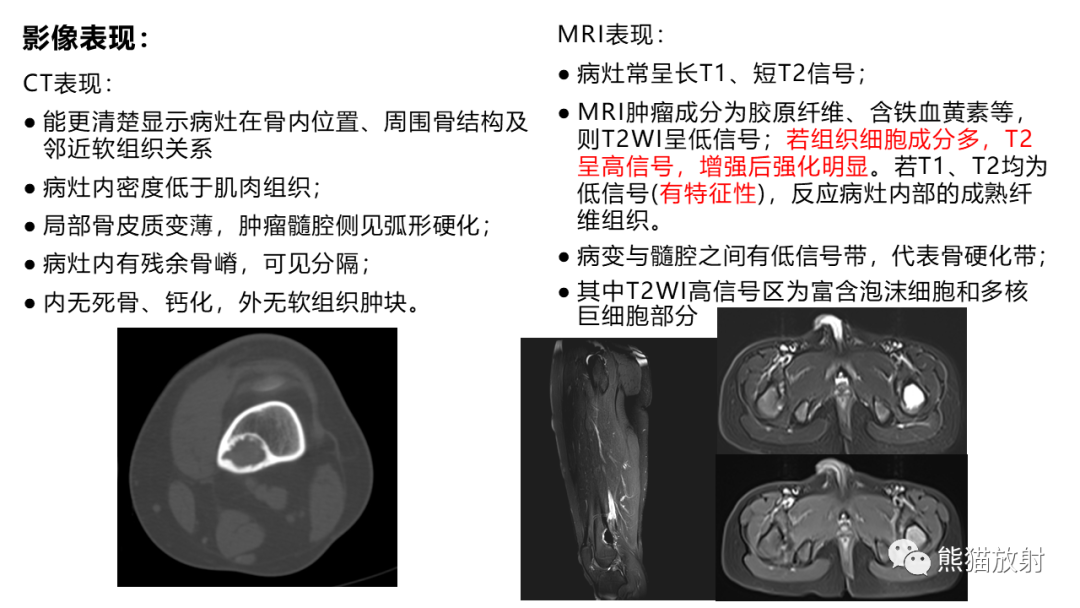 【病例】长骨非骨化性纤维瘤2例X线CT及MR-27