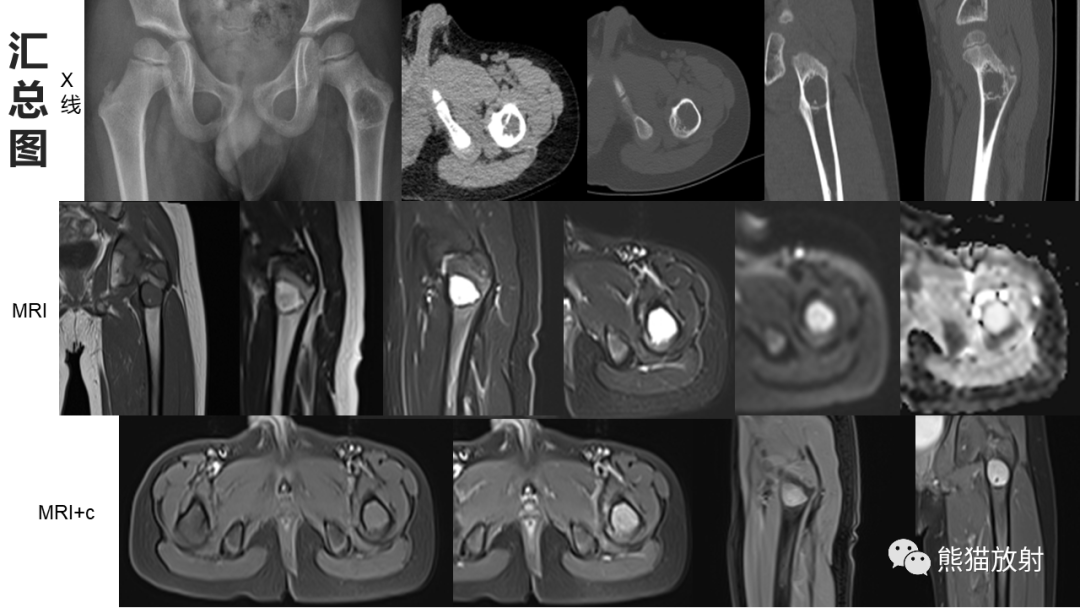 【病例】长骨非骨化性纤维瘤2例X线CT及MR-12