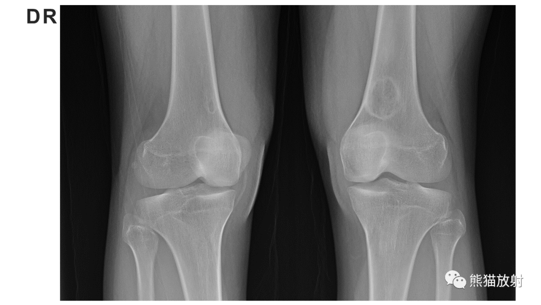 【病例】长骨非骨化性纤维瘤2例X线CT及MR-15