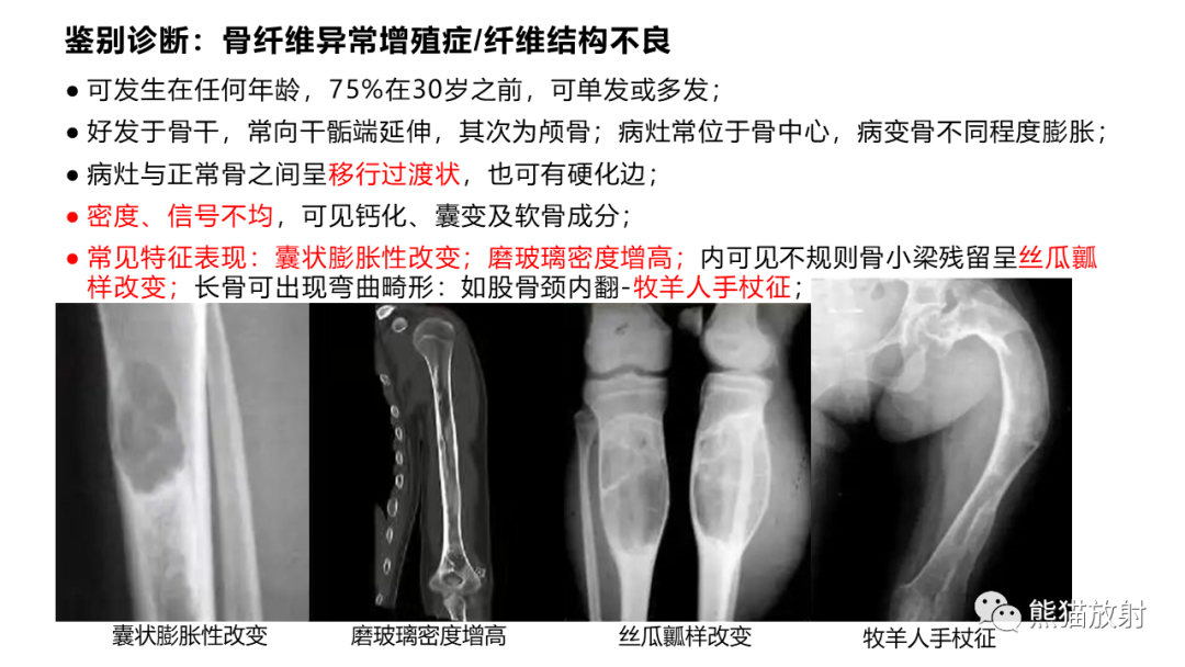 【病例】长骨非骨化性纤维瘤2例X线CT及MR-33