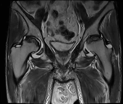 【病例】股骨头缺血性坏死1例X线MR-5