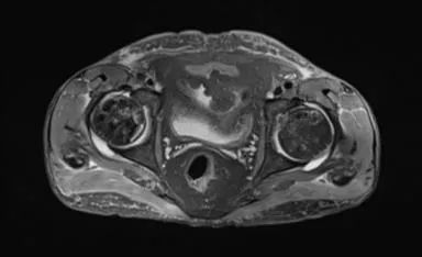 【病例】股骨头缺血性坏死1例X线MR-7