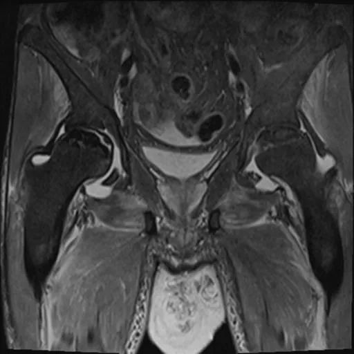 【病例】股骨头缺血性坏死1例X线MR-6