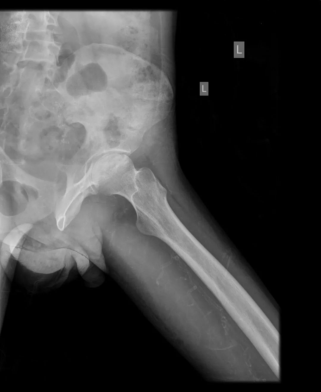 【病例】股骨头缺血性坏死1例X线MR-3