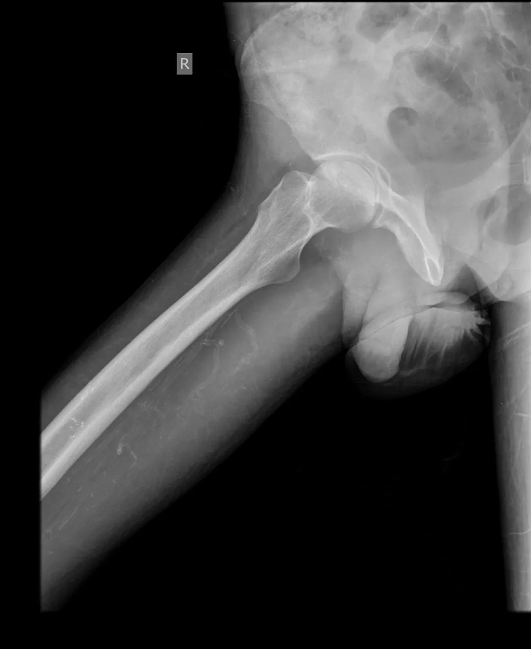 【病例】股骨头缺血性坏死1例X线MR-2