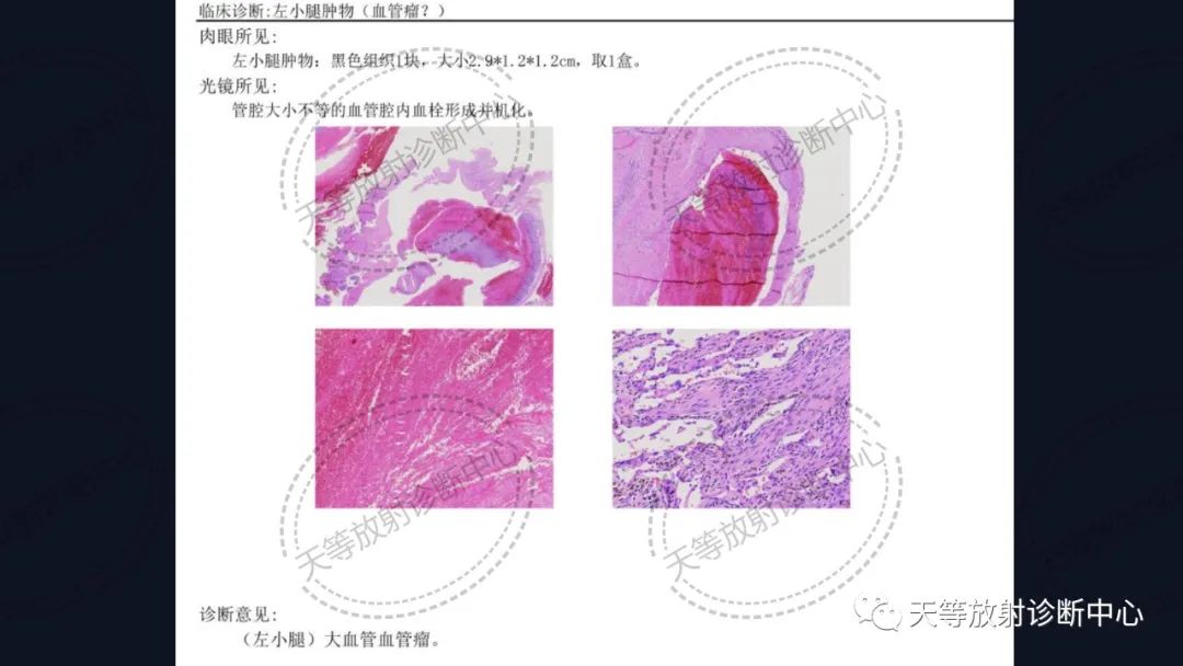 【病例】软组织血管瘤1例MR-16