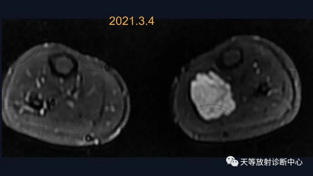 【病例】软组织血管瘤1例MR-8