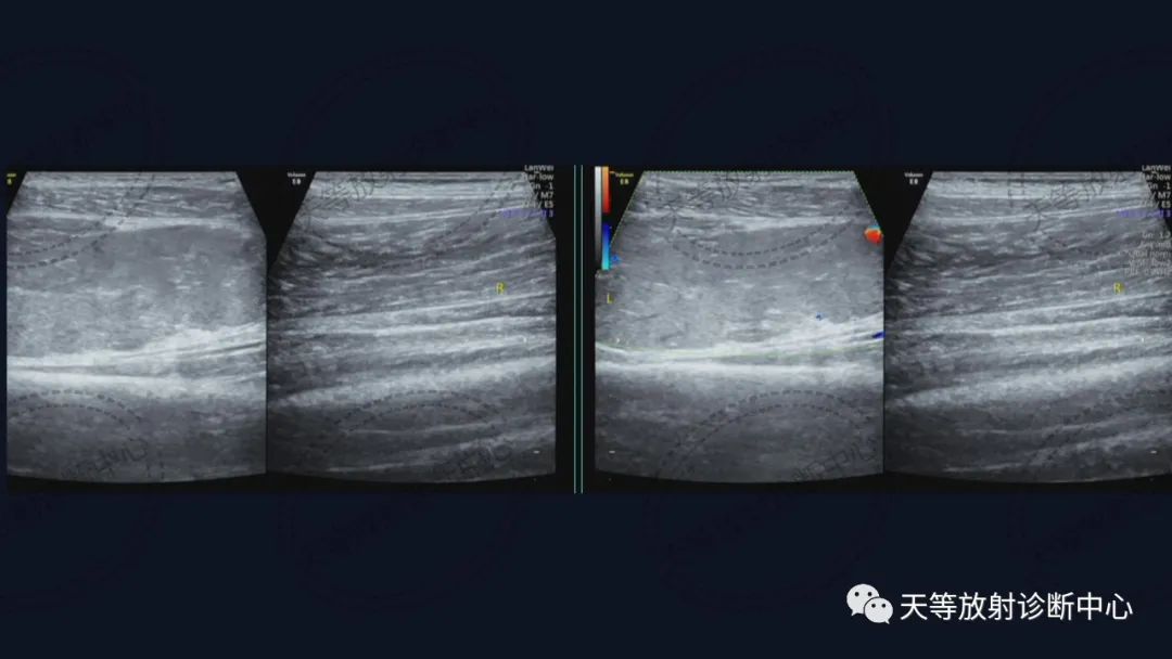 【病例】软组织血管瘤1例MR-5