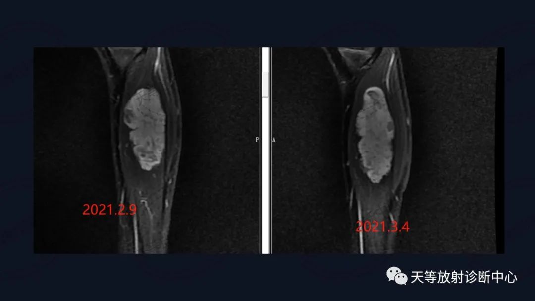 【病例】软组织血管瘤1例MR-11