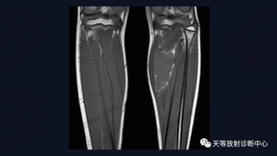 【病例】软组织血管瘤1例MR-10