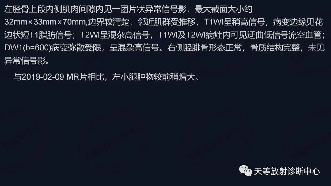 【病例】软组织血管瘤1例MR-14