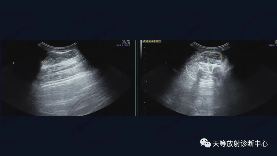 【病例】软组织血管瘤1例MR-3