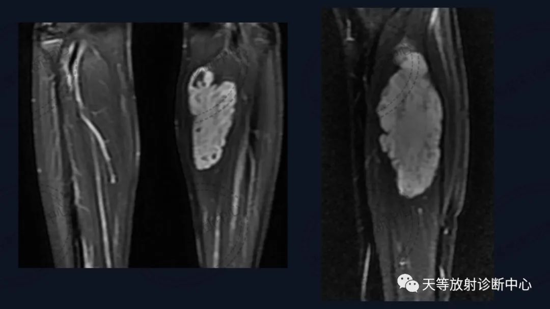 【病例】软组织血管瘤1例MR-9