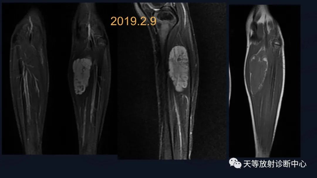 【病例】软组织血管瘤1例MR-7