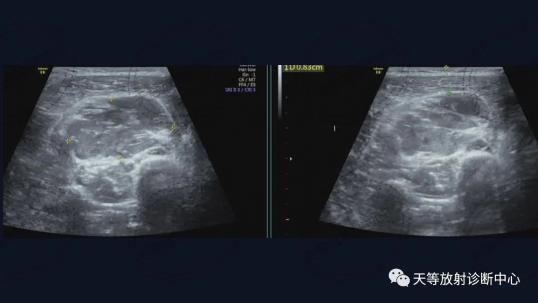 【病例】软组织血管瘤1例MR-2