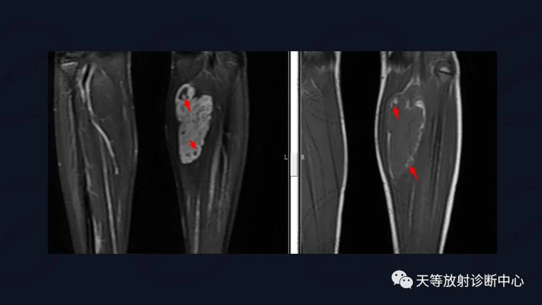 【病例】软组织血管瘤1例MR-13