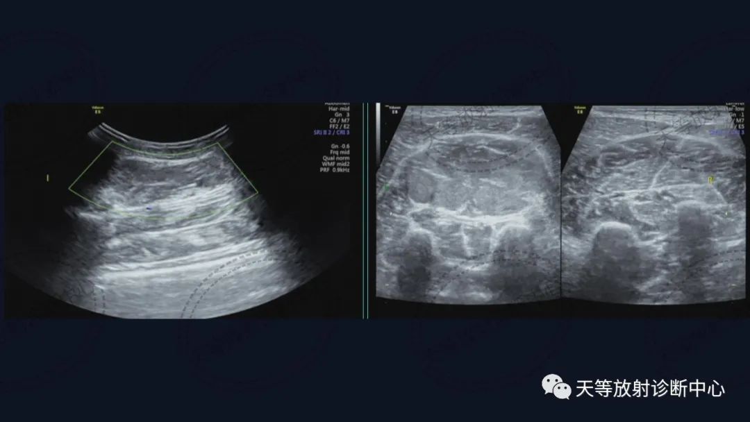 【病例】软组织血管瘤1例MR-4