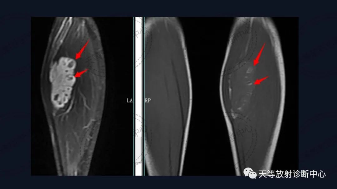 【病例】软组织血管瘤1例MR-12