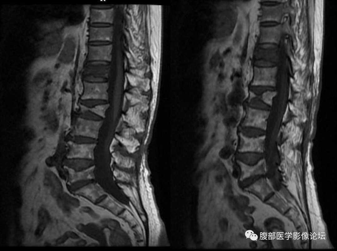 【病例】一例压缩性骨折所引起的思考​-3