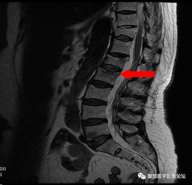 【病例】一例压缩性骨折所引起的思考​-5