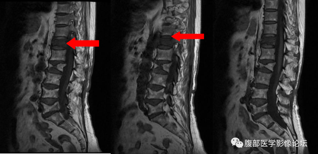 【病例】一例压缩性骨折所引起的思考​-2