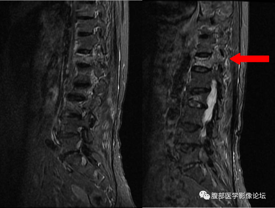 【病例】一例压缩性骨折所引起的思考​-4
