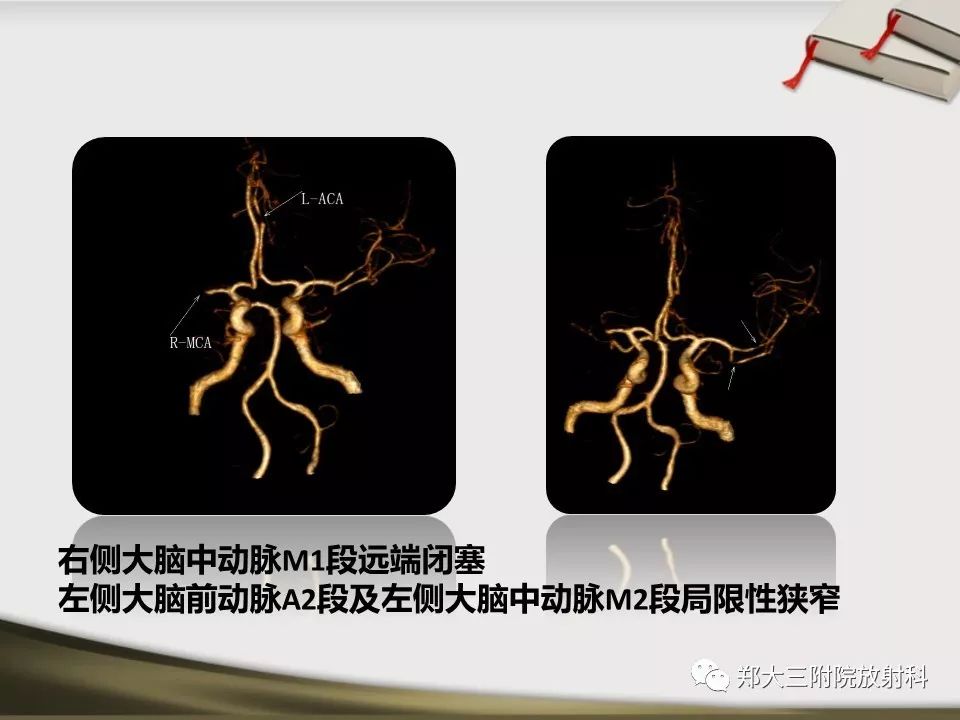【PPT】头颈联合CTA临床应用