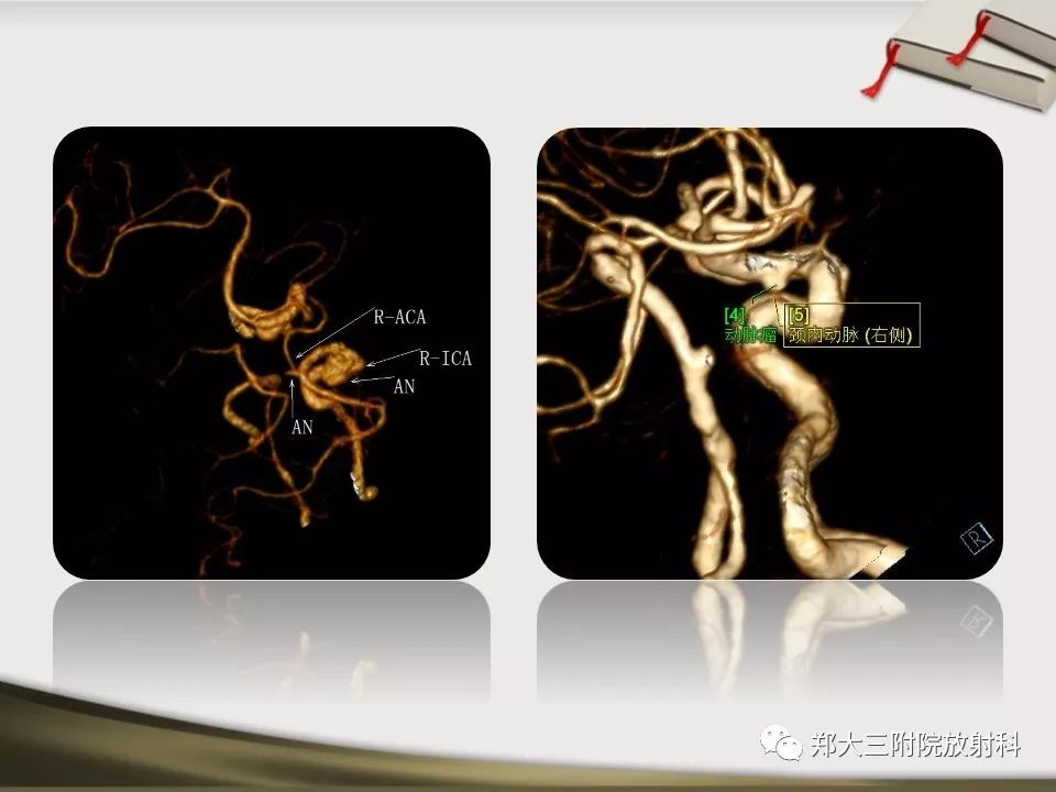 【PPT】头颈联合CTA临床应用