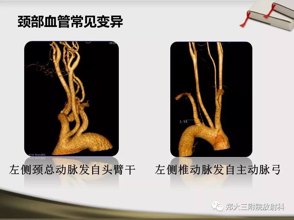 【PPT】头颈联合CTA临床应用