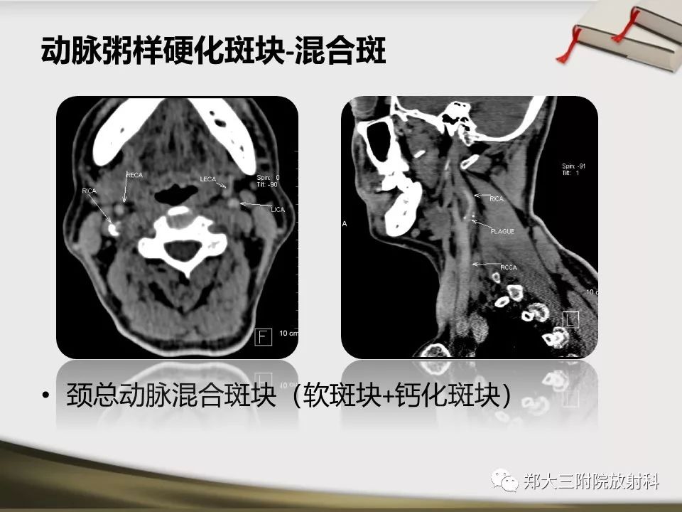 【PPT】头颈联合CTA临床应用