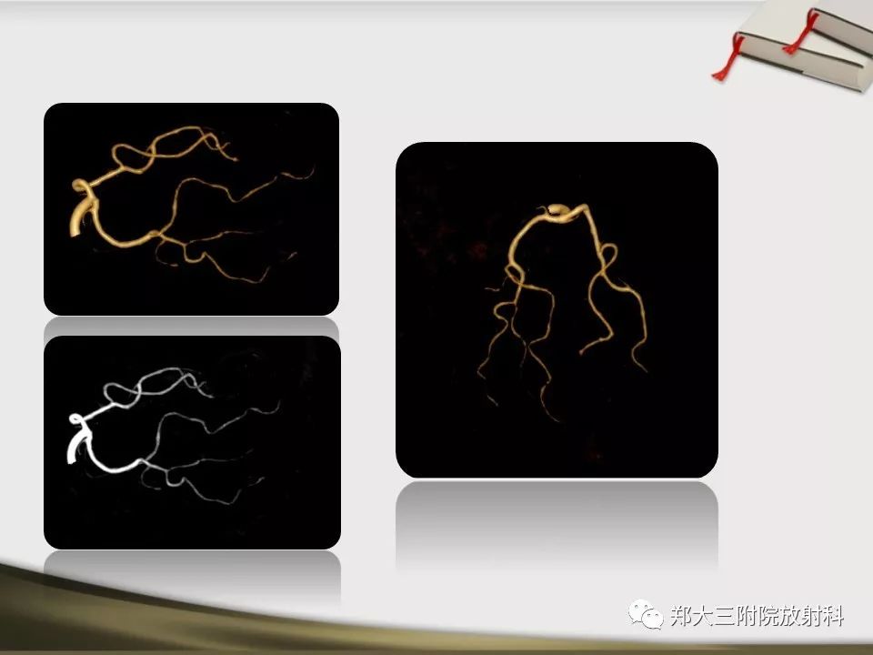 【PPT】头颈联合CTA临床应用