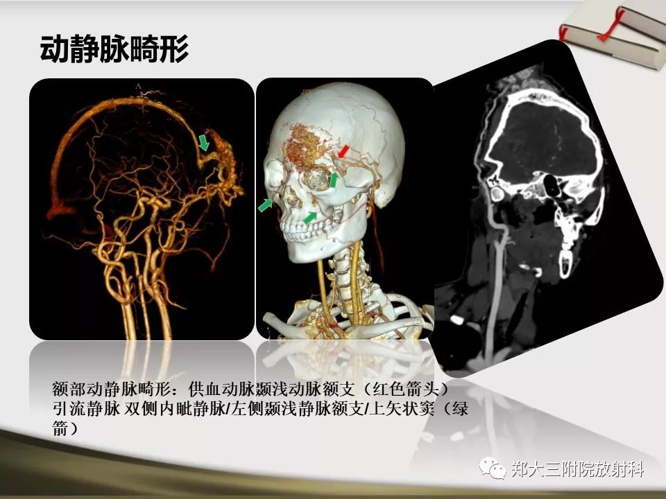 【PPT】头颈联合CTA临床应用