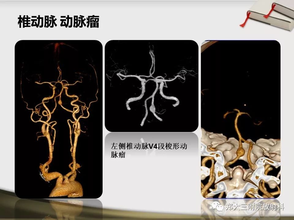 【PPT】头颈联合CTA临床应用